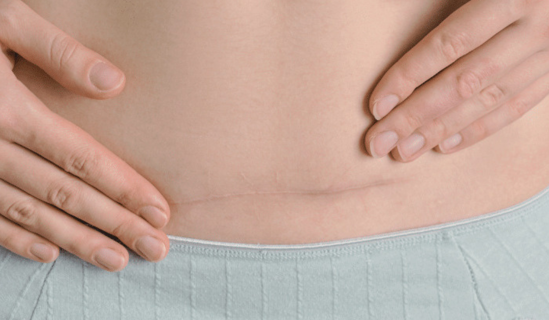 C-Section Scars & Your Body After Birth