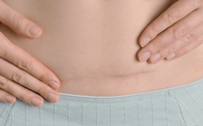 C-Section Scars & Your Body After Birth